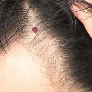 How Long Does It Take To Remove A Cherry Angioma?